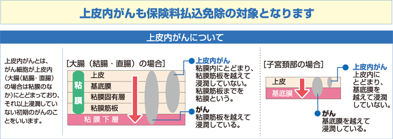 上皮内がんについて